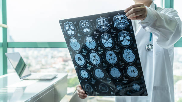 The Cost of Treating Traumatic Brain Injuries