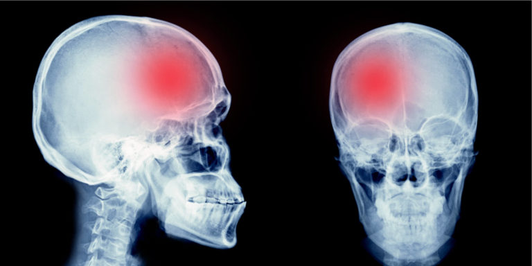 Common Semi-Truck Accident Injuries